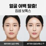 얼굴 여백 줄이는 시술