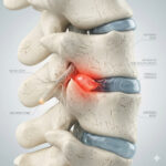 lumbar-disc-treatment-cost-guide